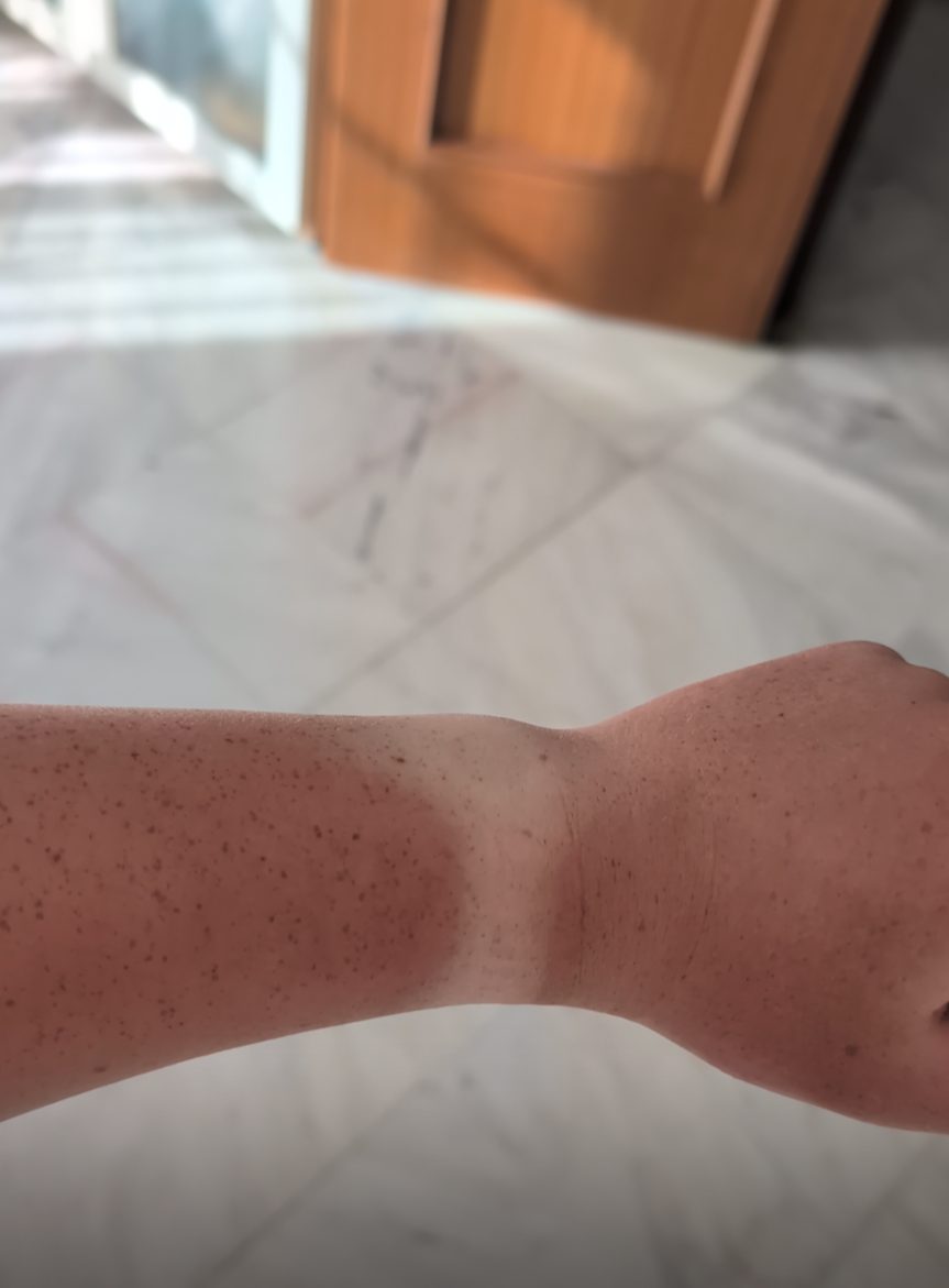 A very defined watch tan line after three weeks training in the sun